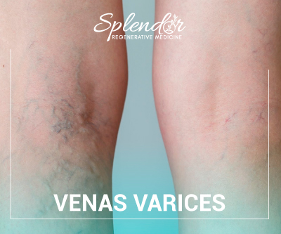 Venas Varicosas en Splendor Regenerative Medicine