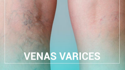 Varicose Vein