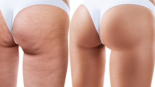 Levantamientos de Gluteos