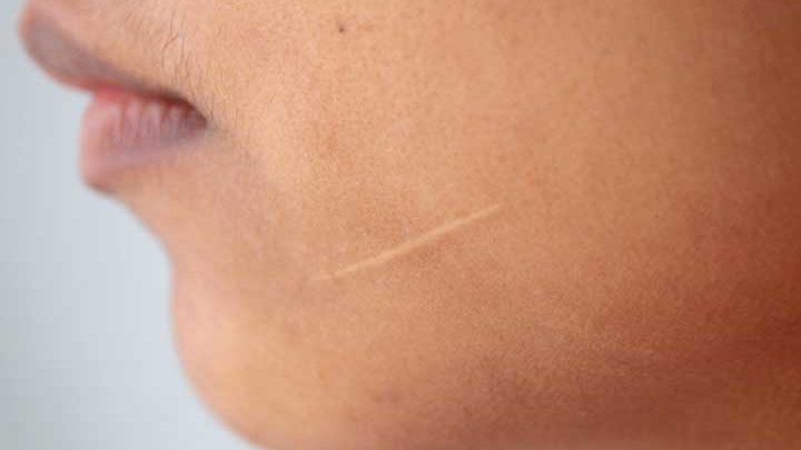 What is a keloid scar?